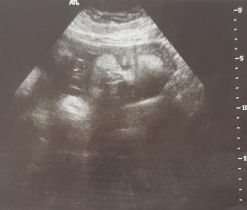 ultrasound